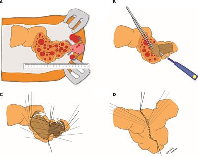 Clinical Phenotypes of Tumors Invading the Rectosigmoid Colon Affecting the Extent of Debulking Surgery and Survival in Advanced Ovarian Cancer